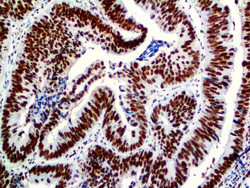 PMS2 Antibody Immunohistochemistry on a FFPE Colon Carcinoma Tissue